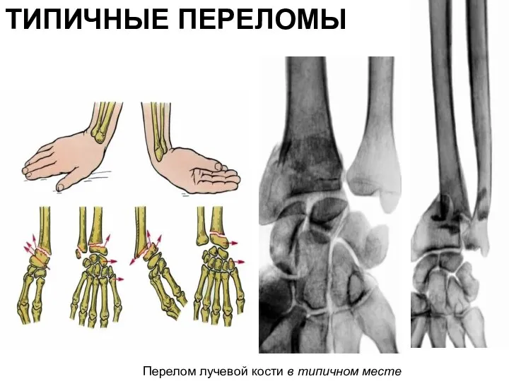 ТИПИЧНЫЕ ПЕРЕЛОМЫ