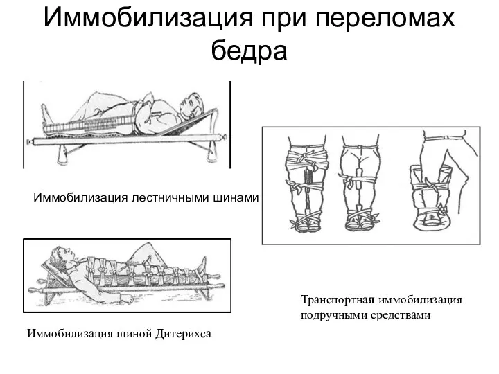 Иммобилизация лестничными шинами Транспортная иммобилизация подручными средствами Иммобилизация шиной Дитерихса Иммобилизация при переломах бедра