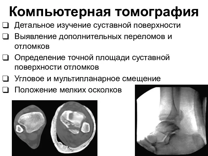 Компьютерная томография Детальное изучение суставной поверхности Выявление дополнительных переломов и отломков Определение