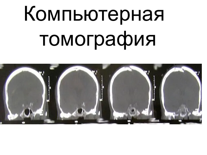 Компьютерная томография