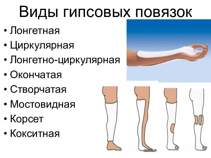 Виды гипсовых повязок Лонгетная Циркулярная Лонгетно-циркулярная Окончатая Створчатая Мостовидная Корсет Кокситная