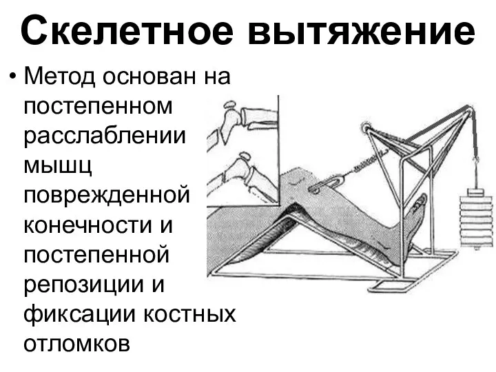 Скелетное вытяжение Метод основан на постепенном расслаблении мышц поврежденной конечности и постепенной