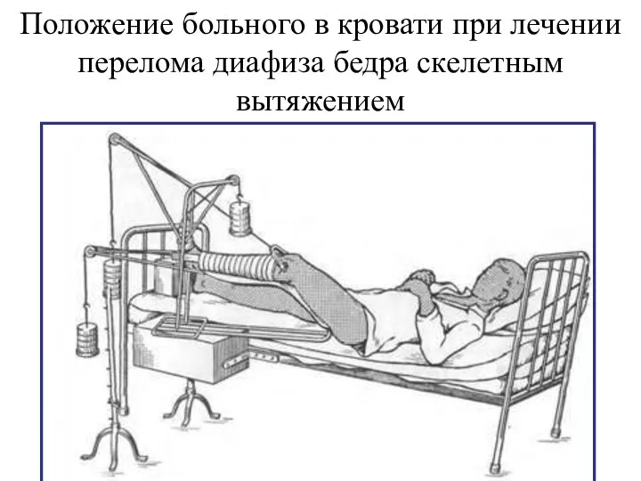 Положение больного в кровати при лечении перелома диафиза бедра скелетным вытяжением