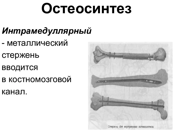 Остеосинтез Интрамедуллярный - металлический стержень вводится в костномозговой канал.