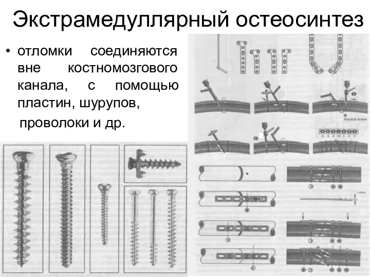 Экстрамедуллярный остеосинтез отломки соединяются вне костномозгового канала, с помощью пластин, шурупов, проволоки и др.