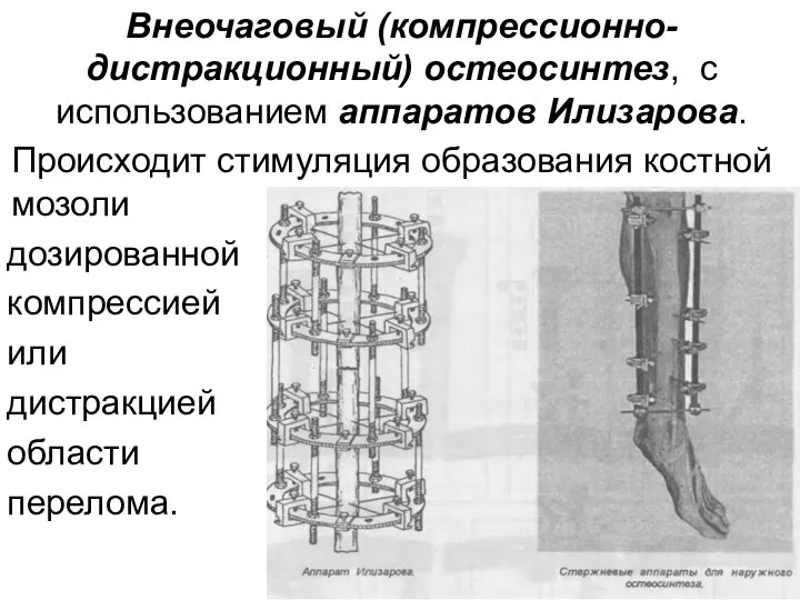 Внеочаговый (компрессионно-дистракционный) остеосинтез, с использованием аппаратов Илизарова. Происходит стимуляция образования костной мозоли