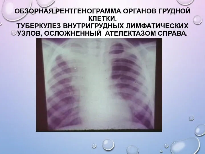 ОБЗОРНАЯ РЕНТГЕНОГРАММА ОРГАНОВ ГРУДНОЙ КЛЕТКИ. ТУБЕРКУЛЕЗ ВНУТРИГРУДНЫХ ЛИМФАТИЧЕСКИХ УЗЛОВ, ОСЛОЖНЕННЫЙ АТЕЛЕКТАЗОМ СПРАВА.