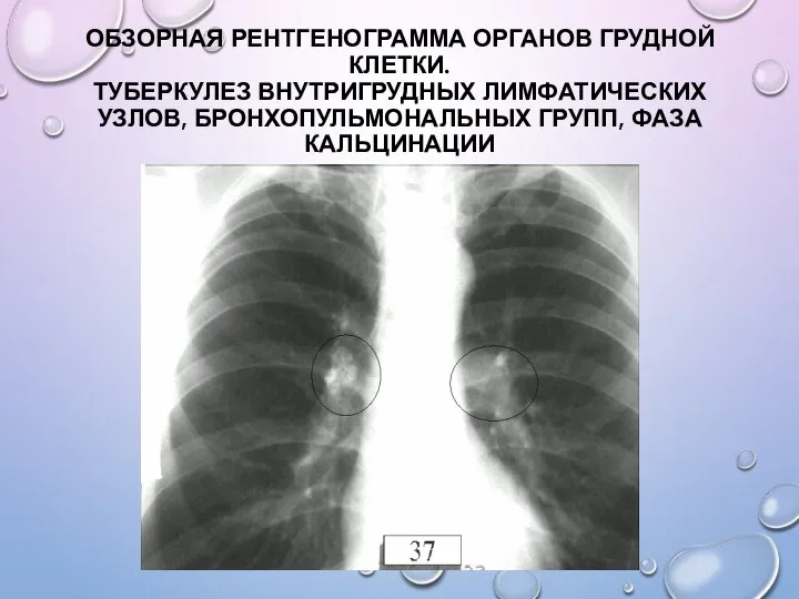 ОБЗОРНАЯ РЕНТГЕНОГРАММА ОРГАНОВ ГРУДНОЙ КЛЕТКИ. ТУБЕРКУЛЕЗ ВНУТРИГРУДНЫХ ЛИМФАТИЧЕСКИХ УЗЛОВ, БРОНХОПУЛЬМОНАЛЬНЫХ ГРУПП, ФАЗА КАЛЬЦИНАЦИИ