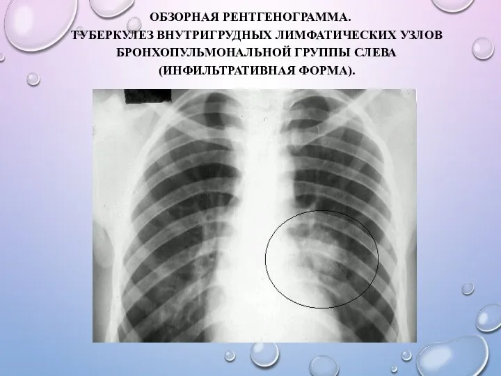ОБЗОРНАЯ РЕНТГЕНОГРАММА. ТУБЕРКУЛЕЗ ВНУТРИГРУДНЫХ ЛИМФАТИЧЕСКИХ УЗЛОВ БРОНХОПУЛЬМОНАЛЬНОЙ ГРУППЫ СЛЕВА (ИНФИЛЬТРАТИВНАЯ ФОРМА).