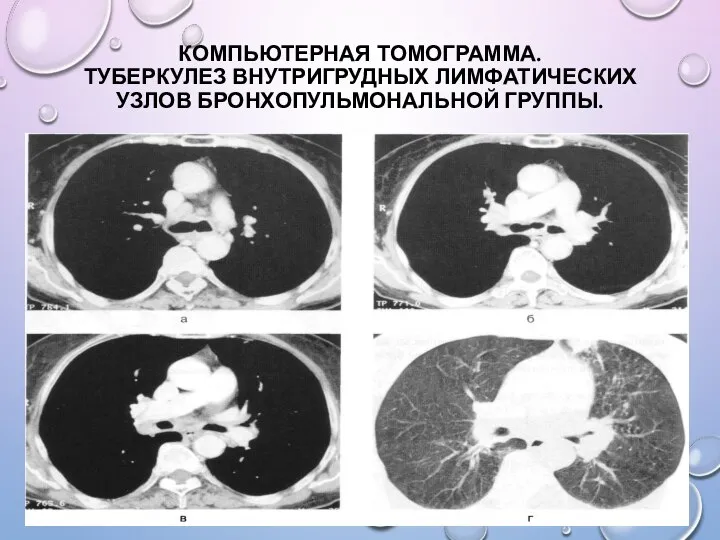 КОМПЬЮТЕРНАЯ ТОМОГРАММА. ТУБЕРКУЛЕЗ ВНУТРИГРУДНЫХ ЛИМФАТИЧЕСКИХ УЗЛОВ БРОНХОПУЛЬМОНАЛЬНОЙ ГРУППЫ.