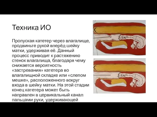 Техника ИО Пропуская катетер через влагалище, продвиньте рукой вперёд шейку матки, удерживая