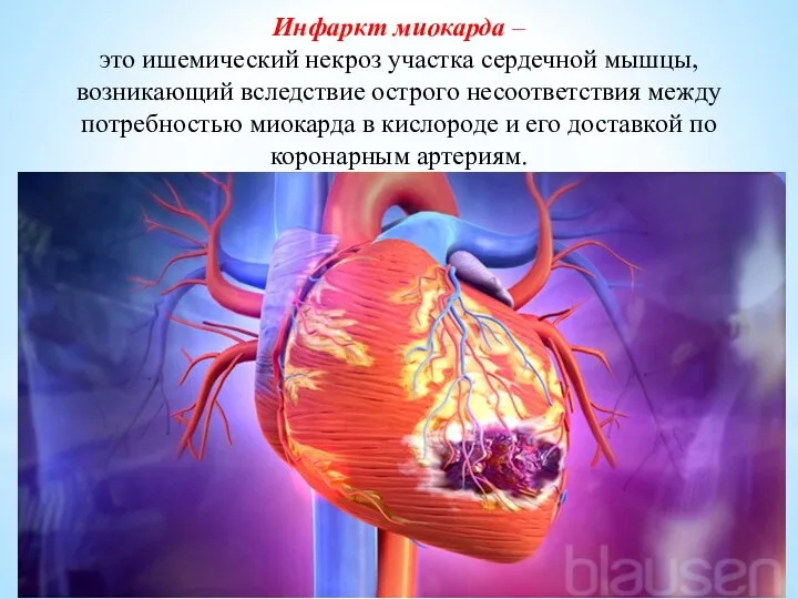 Инфаркт миокарда – это ишемический некроз участка сердечной мышцы, возникающий вследствие острого