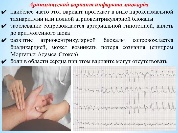 Аритмический вариант инфаркта миокарда наиболее часто этот вариант протекает в виде пароксизмальной