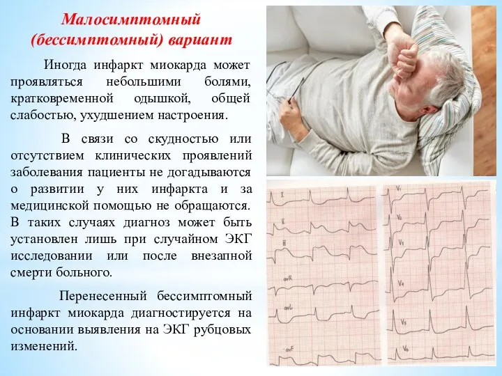 Малосимптомный (бессимптомный) вариант Иногда инфаркт миокарда может проявляться небольшими болями, кратковременной одышкой,