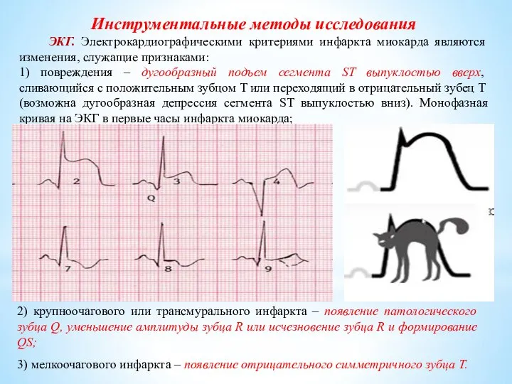 Инструментальные методы исследования ЭКГ. Электрокардиографическими критериями инфаркта миокарда являются изменения, служащие признаками: