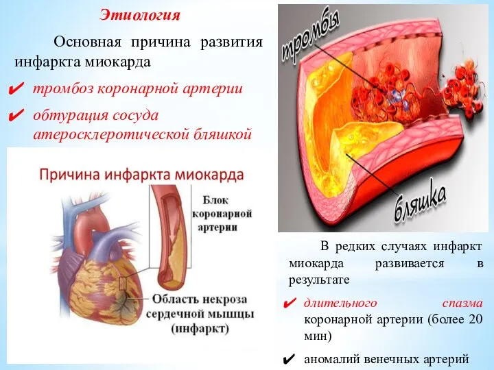 Этиология Основная причина развития инфаркта миокарда тромбоз коронарной артерии обтурация сосуда атеросклеротической