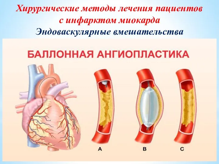 Хирургические методы лечения пациентов с инфарктом миокарда Эндоваскулярные вмешательства