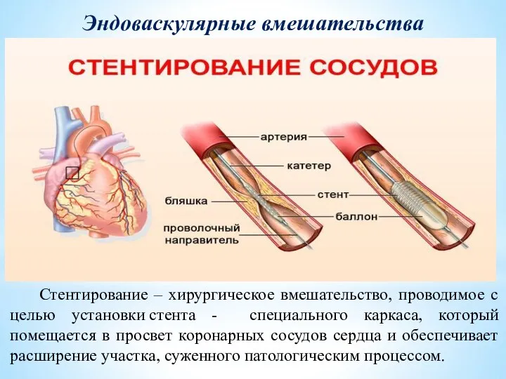 Стентирование – хирургическое вмешательство, проводимое с целью установки стента - специального каркаса,