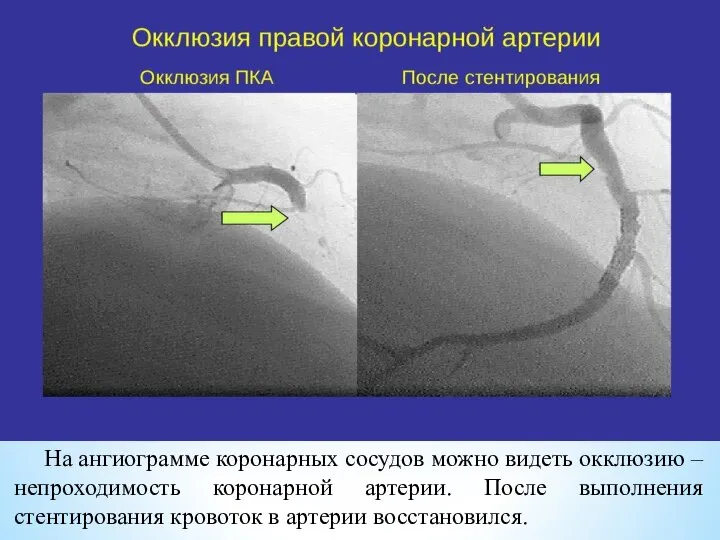 На ангиограмме коронарных сосудов можно видеть окклюзию – непроходимость коронарной артерии. После