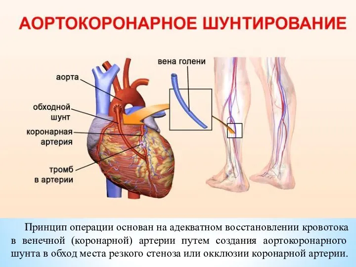 Принцип операции основан на адекватном восстановлении кровотока в венечной (коронарной) артерии путем