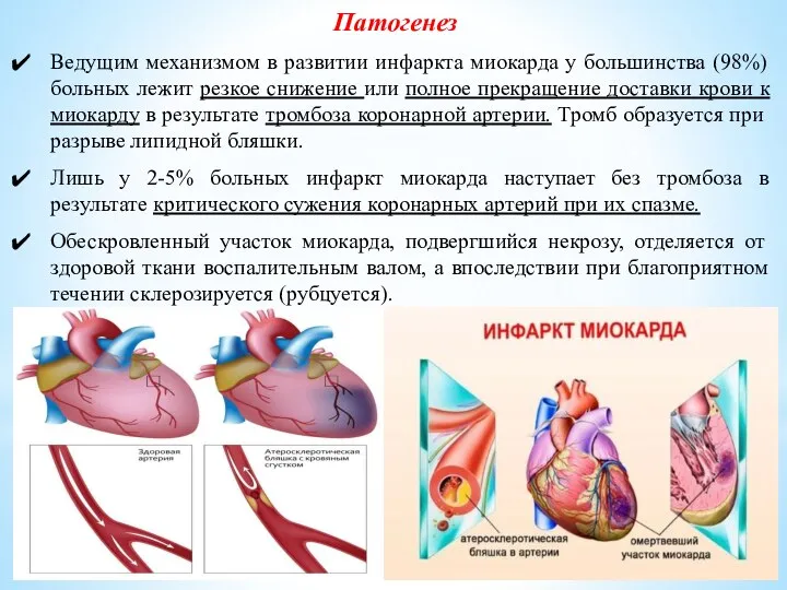 Патогенез Ведущим механизмом в развитии инфаркта миокарда у большинства (98%) больных лежит