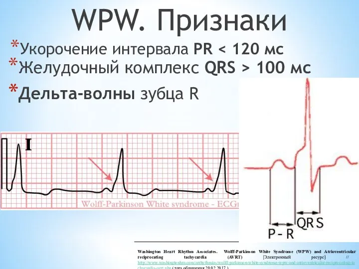 WPW. Признаки Укорочение интервала PR Washington Heart Rhythm Associates. Wolff-Parkinson White Syndrome