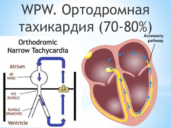 WPW. Ортодромная тахикардия (70-80%)