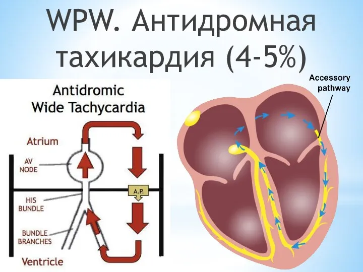 WPW. Антидромная тахикардия (4-5%)