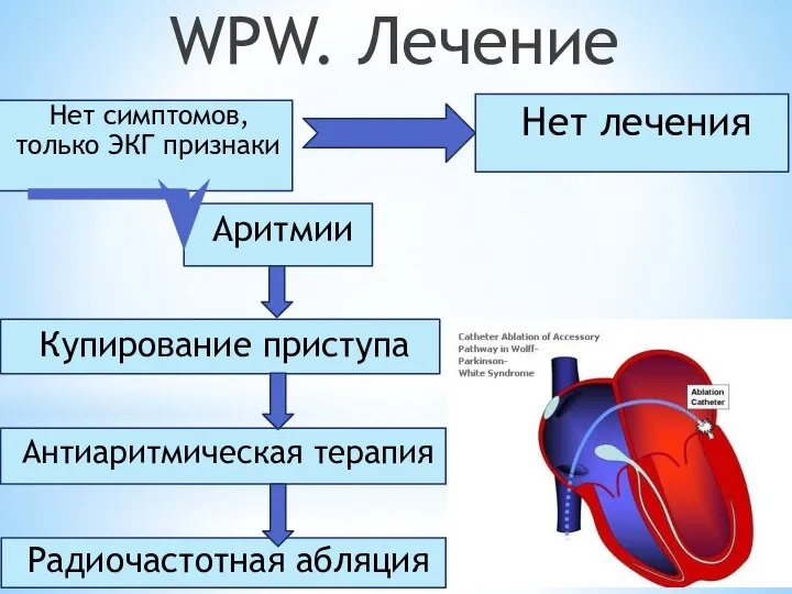 WPW. Лечение Нет симптомов, только ЭКГ признаки Нет лечения Аритмии Купирование приступа Антиаритмическая терапия Радиочастотная абляция