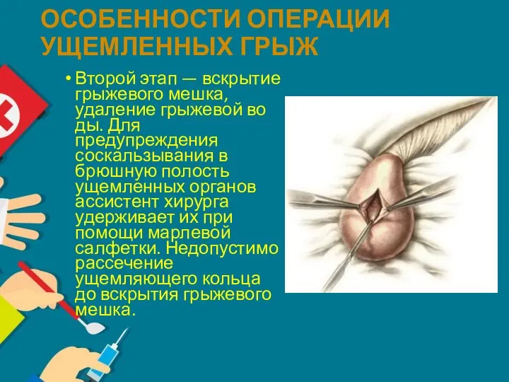 ОСОБЕННОСТИ ОПЕРАЦИИ УЩЕМЛЕННЫХ ГРЫЖ Второй этап — вскрытие грыжевого мешка, удаление грыжевой