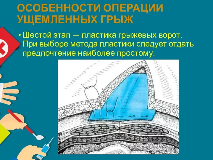 ОСОБЕННОСТИ ОПЕРАЦИИ УЩЕМЛЕННЫХ ГРЫЖ Шестой этап — пластика грыжевых ворот. При выборе