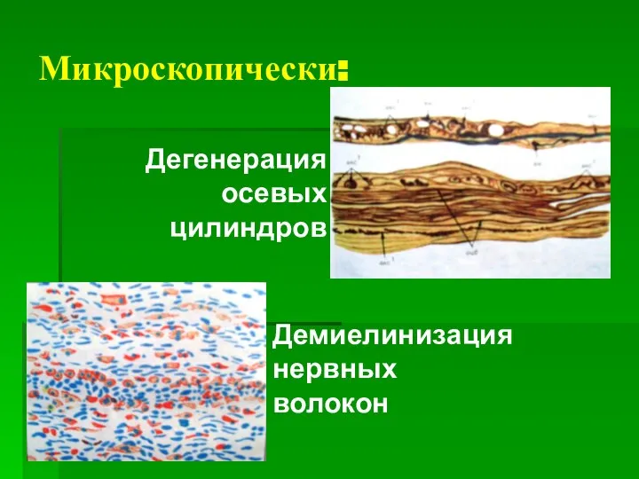Микроскопически: Дегенерация осевых цилиндров Демиелинизация нервных волокон