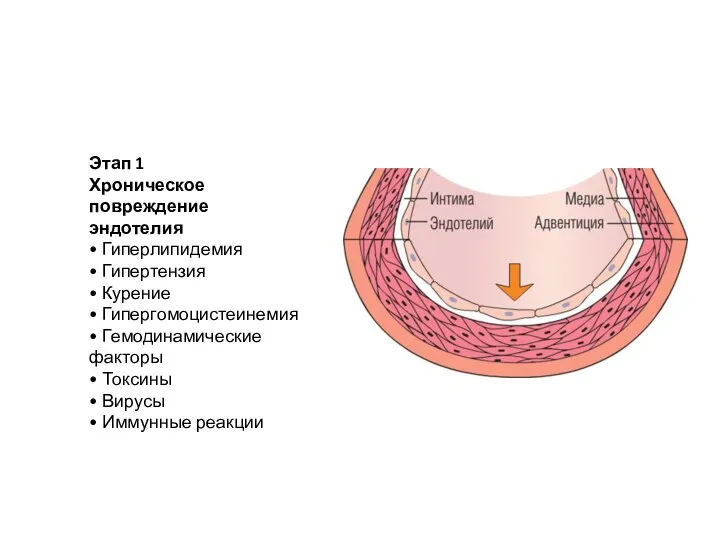 Этап 1 Хроническое повреждение эндотелия • Гиперлипидемия • Гипертензия • Курение •