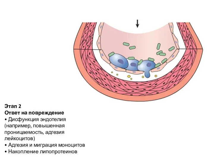 Этап 2 Ответ на повреждение • Дисфункция эндотелия (например, повышенная проницаемость, адгезия