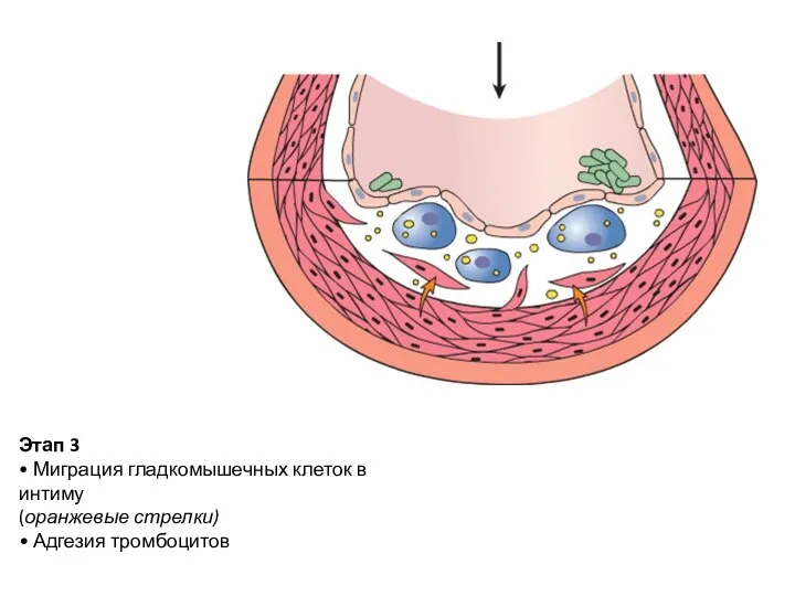 Этап 3 • Миграция гладкомышечных клеток в интиму (оранжевые стрелки) • Адгезия тромбоцитов