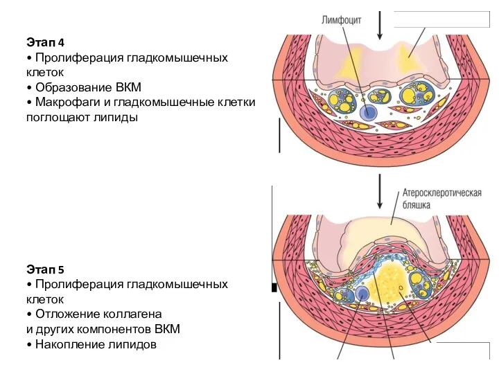 Этап 4 • Пролиферация гладкомышечных клеток • Образование ВКМ • Макрофаги и