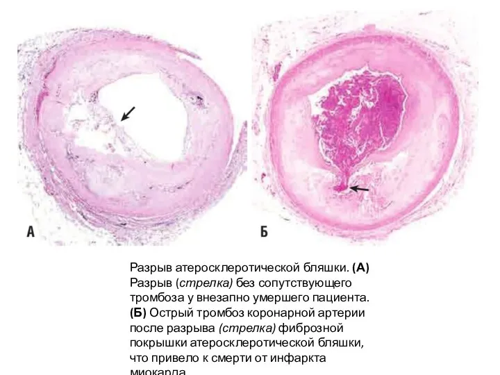 Разрыв атеросклеротической бляшки. (А) Разрыв (стрелка) без сопутствующего тромбоза у внезапно умершего