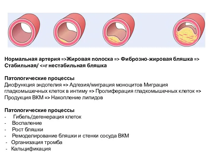 Нормальная артерия =>Жировая полоска => Фиброзно-жировая бляшка => Стабильная/ Патологические процессы Дисфункция