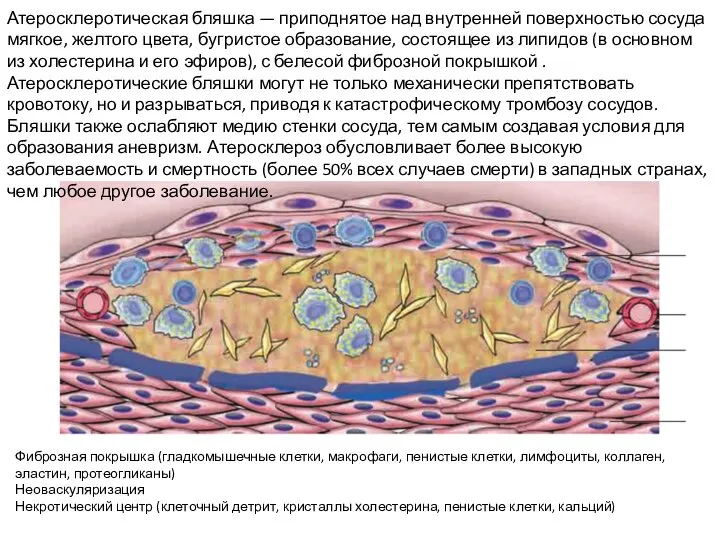 Фиброзная покрышка (гладкомышечные клетки, макрофаги, пенистые клетки, лимфоциты, коллаген, эластин, протеогликаны) Неоваскуляризация