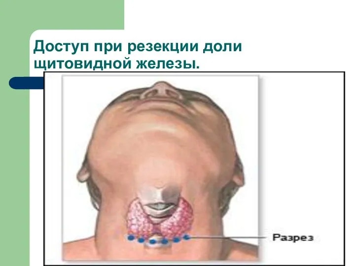 Доступ при резекции доли щитовидной железы.