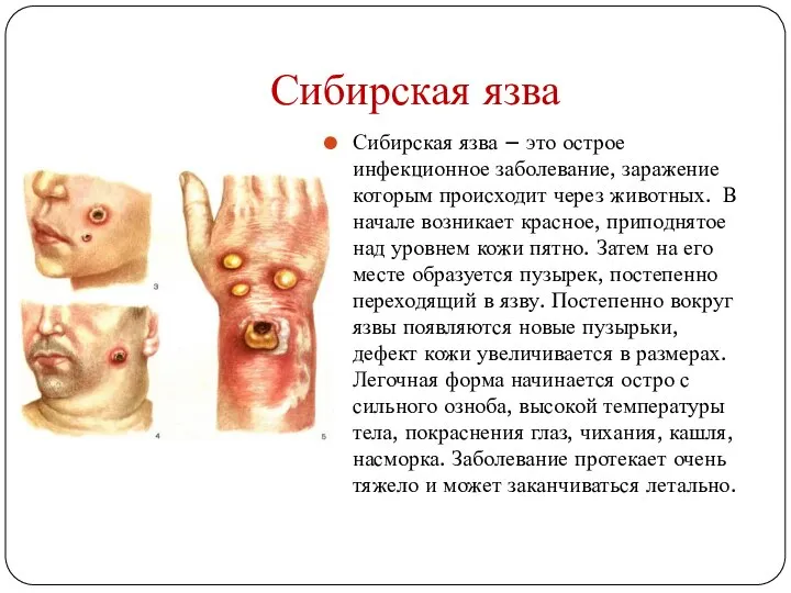 Сибирская язва Сибирская язва – это острое инфекционное заболевание, заражение которым происходит