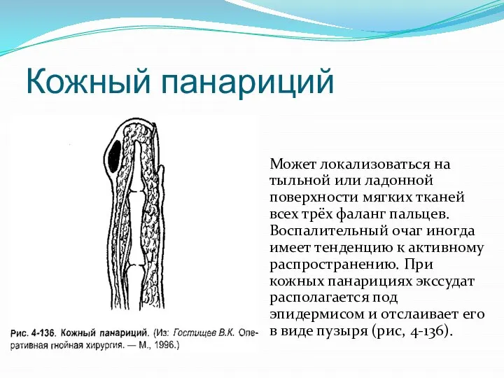 Кожный панариций Может локализоваться на тыльной или ладонной поверхности мягких тканей всех