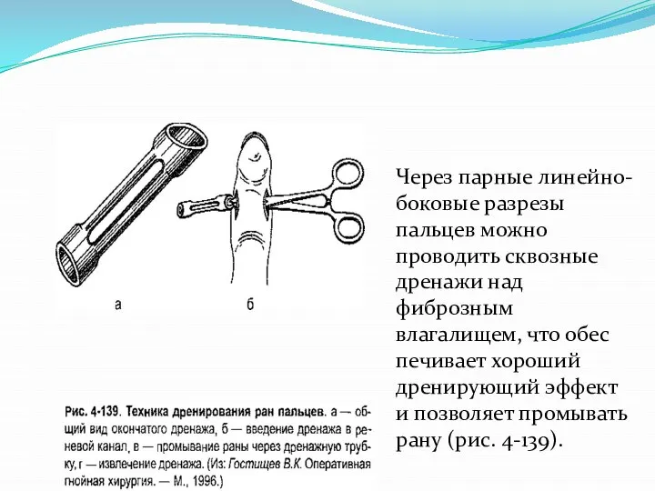 Через парные линейно-боковые раз­резы пальцев можно проводить сквозные дре­нажи над фиброзным влагалищем,