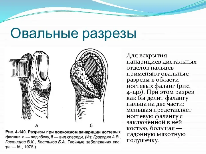 Овальные разрезы Для вскрытия панарициев дистальных от­делов пальцев применяют овальные разрезы в