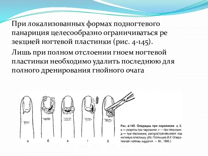 При локализованных формах подногтевого панариция целесообразно ограничиваться ре­зекцией ногтевой пластинки (рис. 4-145).