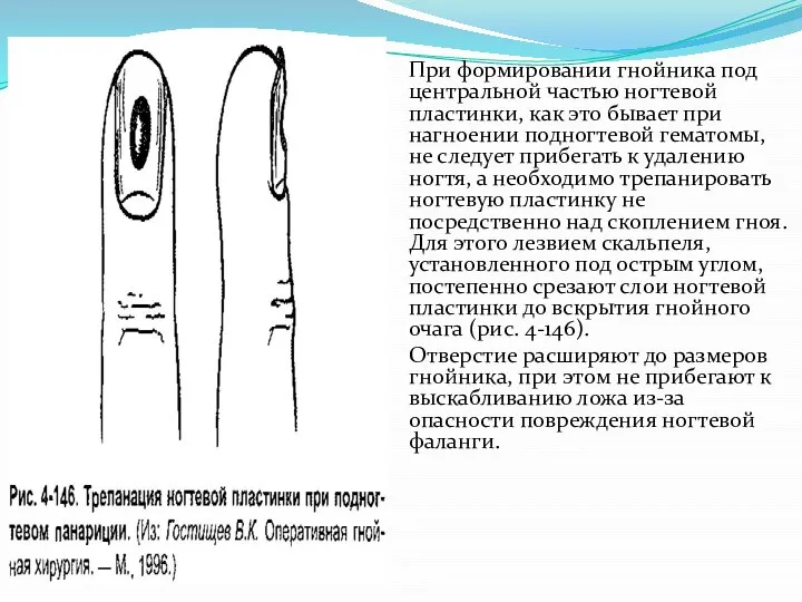 При формировании гнойника под централь­ной частью ногтевой пластинки, как это бы­вает при