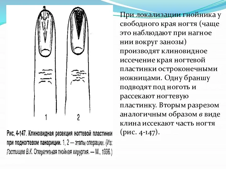 При локализации гнойника у свободного края ногтя (чаще это наблюдают при нагное­нии