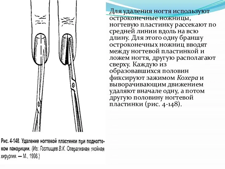 Для удаления ногтя используют остроконеч­ные ножницы, ногтевую пластинку рассекают по средней линии