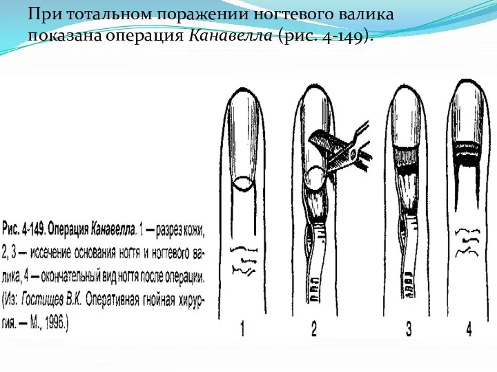 При тотальном поражении ногтевого вали­ка показана операция Канавелла (рис. 4-149).
