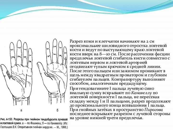 Разрез кожи и клетчатки начинают на 2 см проксимальыее шиловидного отростка локте­вой